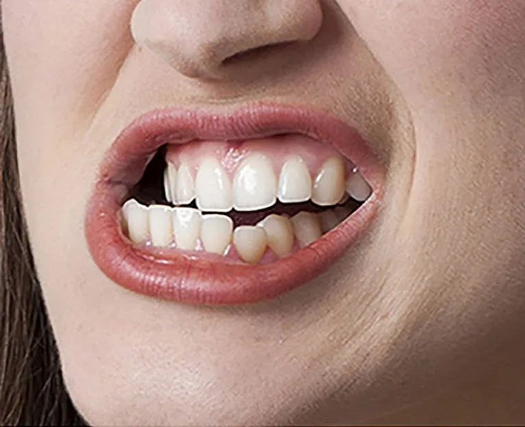 Teeth Grinding: